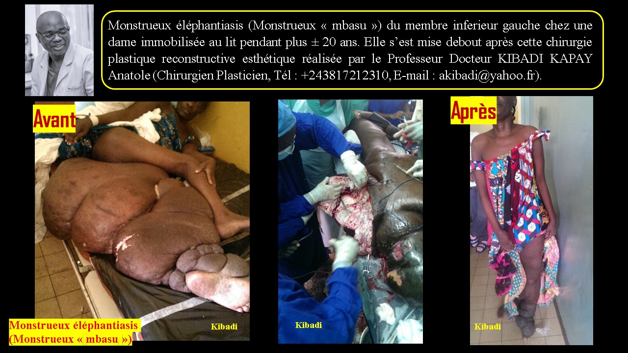 Monstrueux éléphantiasis (Monstrueux « Mbasu ») du membre inferieur gauche chez une dame immobilisée au lit pendant plus ± 20 ans. Elle s’est mise debout après cette chirurgie plastique reconstructive esthétique réalisée par le Professeur Docteur KIBADI KAPAY Anatole (Chirurgien Plasticien, Tél : +243817212310, E-mail : akibadi@yahoo.fr).